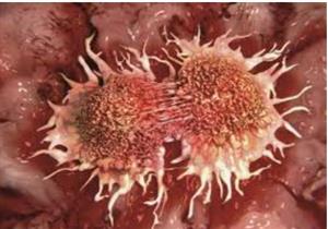 دراسة: وجود بكتريا في الرئتين يزيد من انتشار السرطان بالجسم