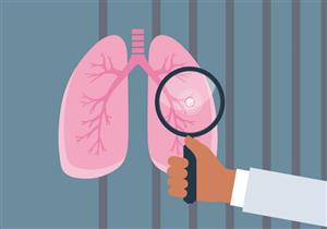 غير المدخنين.. هؤلاء عرضة للإصابة بـ سرطان الرئة