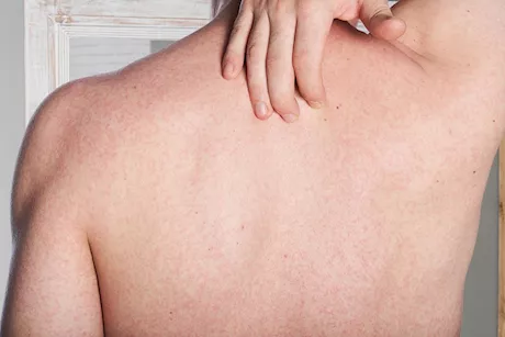 الاستحمام بالماء البارد أم الدافئ في الصيف- أيهما أفضل للوقاية الحمو النيل؟