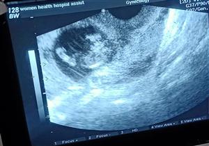 جراحة ناجحة لاستئصال حمل خارج الرحم في أسيوط