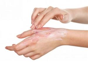 كيف نخفف آلام حروق الشمس وكيف نحتمي؟