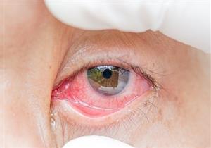 فيروس كورونا يمكن أن يعيش في العينين لمدة أسابيع