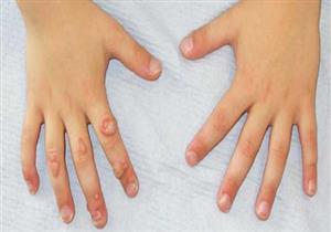  هل تعرضت لـ"نفرة الحمار" من قبل؟.. إليك ما تريد معرفته عن فيروس السنط