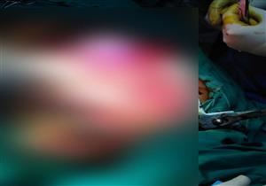 فريق طبي ينقذ طفلًا سقط على سيخ حديدي في طنطا- صور