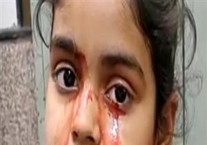 حالة طبية تحير العلماء.. فتاة تبكي "بدل الدموع دم"