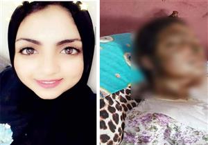 انتقامًا منها.. ضبط المتهم بتشويه وجه مخطوبته في القليوبية -صور