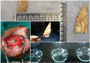 استخراج سكين من عين مريض في مستشفي الرمد الجامعي بطنطا