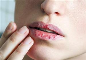 الحروق الشمسية تصيب الشفاه أيضا