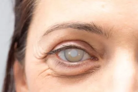 دليلك لحماية العين من المياه الزرقاء - طبيب يوضح  