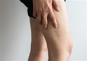 5 عوامل تعرّضِك للإصابة بالخثار الوريدي أثناء الحمل.. إليكِ طريق الوقاية