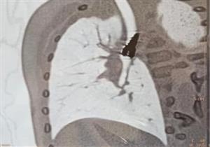 استخراج جسم معدني من القصبة الهوائية لطفل داخل مستشفى جامعة أسيوط
