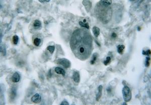 تسجيل إصابة بنوع نادر من أميبا آكلة للدماغ في فلوريدا