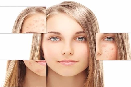 وداعًا لتصبغات الوجه- زيوت تساعدِك على التخلص منها