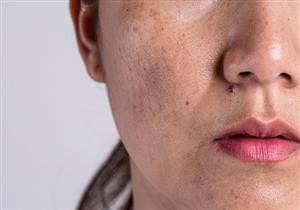 تعانين منها في فصل الصيف؟.. 5 نصائح للوقاية من التصبغات الجلدية