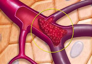 احذر التدخين والسمنة.. 6 عوامل تعرض الشباب للإصابة بالجلطات