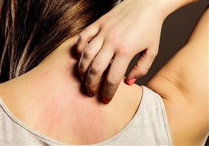 احرص على حمام الشوفان.. 4 علاجات منزلية للأرتيكاريا