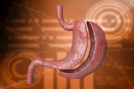 بعد شهر من تكميم المعدة- إليك الأطعمة المسموحة والممنوعة