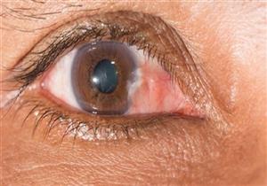 البقع العمياء تشير إلى الإصابة بهذا المرض