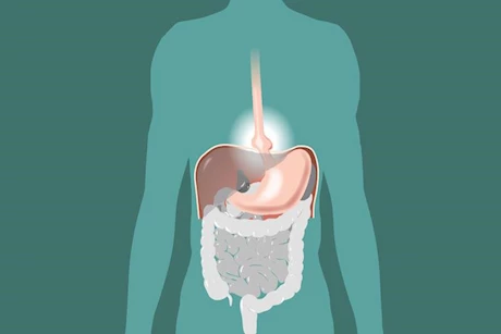 هل فتق الحجاب الحاجز قد يتحول إلى سرطان؟- طبيب يوضح