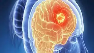علامات لا يجب تجاهلها.. أعراض تكشف إصابتك بسرطان الدماغ مبكرًا