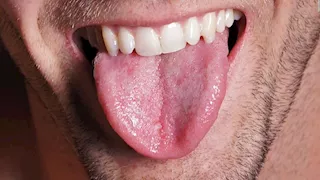 علامة في اللسان والذاكرة مؤشر خطير لنقص فيتامين مهم