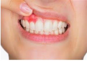 ما أسباب نزيف اللثة المتكرر؟