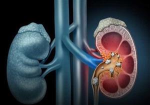 6 طرق طبيعية تمكنك من الوقاية من حصوات الكلى
