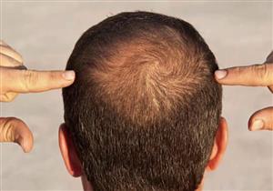 يطرح في الأسواق خلال 6 أشهر.... اكتشاف مستخلص نباتي يمكنه علاج الصلع