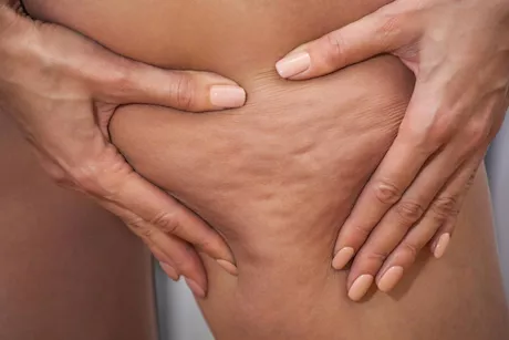 أسباب ظهور السيلوليت مع التقدم في العمر.. تعرف عليها    