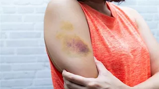 أسباب ظهور كدمات عند الاستيقاظ صباحا.. متى يجب زيارة الطبيب؟ 