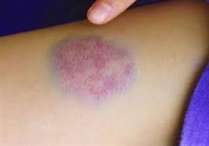 ما أسباب ظهور بقع زرقاء على الجسم؟