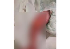 جلدها يتمزق بمجرد لمسه.. مولودة مصابة بمرض نادر في الأقصر