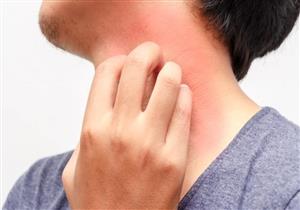 ما أسباب الحكة؟