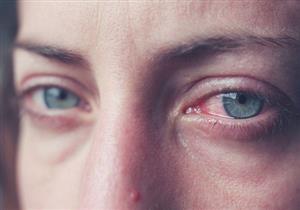 التهاب العين الفيروسي.. ما هي أعراضه وطرق علاجه؟