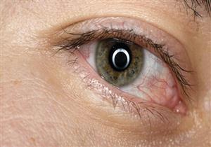 ما هو التهاب ملتحمة العين؟