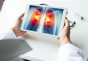 خبير: أوميكرون يزيد فرص الإصابة بالالتهاب الرئوي