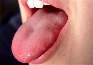 الشعور بحرقان في اللسان.. علام يدل؟