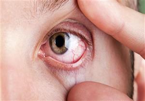سرطان العين.. الأسباب والأعراض والعلاج