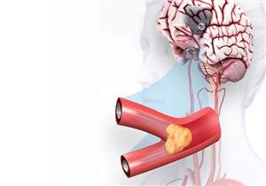 5 تغييرات أساسية في نمط حياتك تحميك من السكتات الدماغية