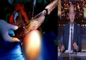 "استمرت لـ7 ساعات".. عميد طب سوهاج يكشف كواليس إنقاذ "سيدة الساطور"