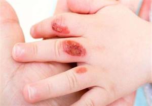 هكذا تتعامل مع حروق الأطفال