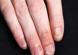 أظافرك متشققة؟ إليك الحل