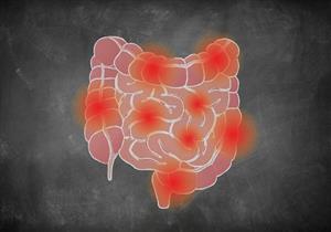 مائدة مرضى كرون الرمضانية.. 5 أطعمة ممنوعة على الإفطار والسحور