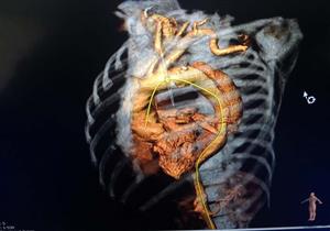 للمرة الأولى.. إجراء عملية "تيفار" بمركز جراحة الأوعية الدموية بجامعة المنصورة- صور