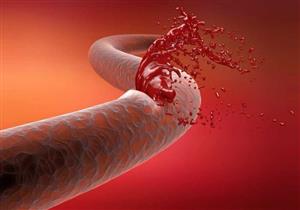 اذهب للطبيب فورًا.. علامة في الجسم تكشف التعرض لنزيف داخلي