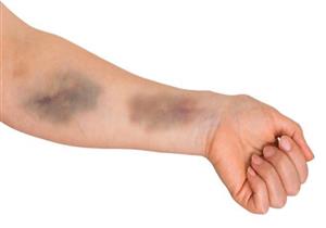 الكدمات الزرقاء في الجسم.. أسبابها وطرق علاجها