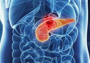  طبيب أورام يحذر من علامات دالة على سرطان البنكرياس