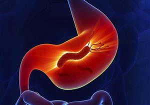 أعراض متعددة لجرثومة المعدة.. متى يمكن التخلص منها؟