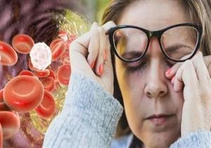 انتبه.. علامة في عينيك تدل على ارتفاع نسبة الكوليسترول