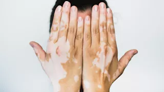 لا تتجاهلها.. بقع على الجلد تكشف مرضا مناعيا خطيرا